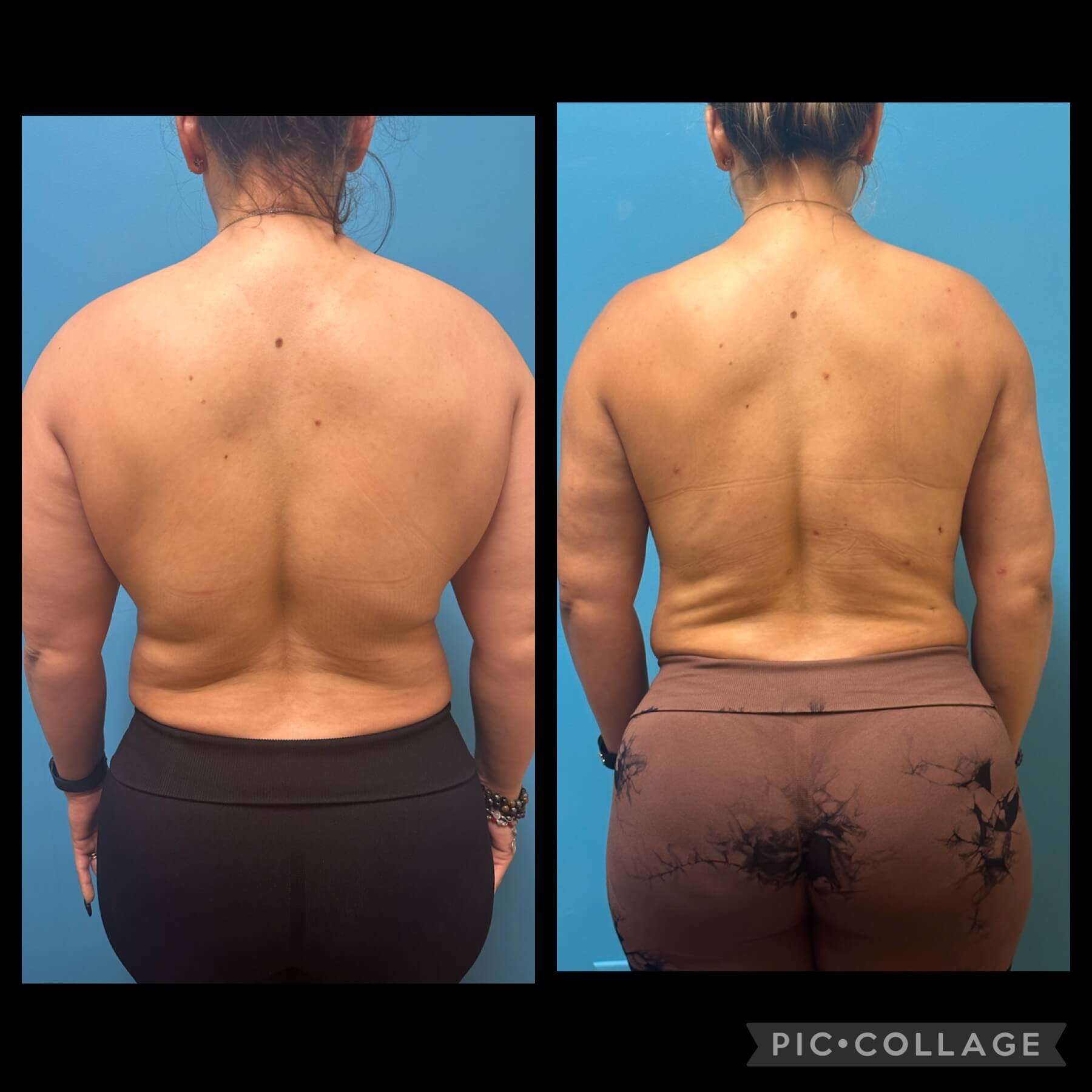 Liposuction 360