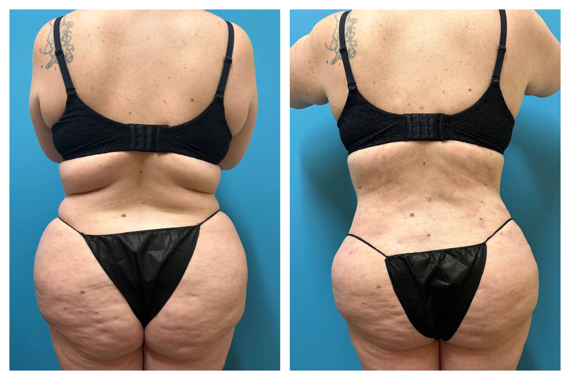 Liposuction 360